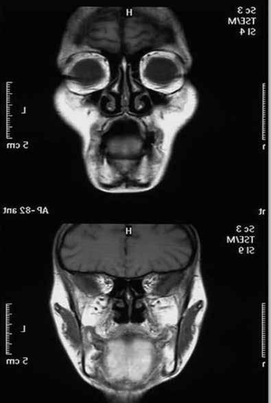 TJN 20; 4: 2014 gastrocnemius medial başı, solues ve peronealis longusun en erken etkilenen kaslar olduğunu ortaya koydu (Tablo 2).