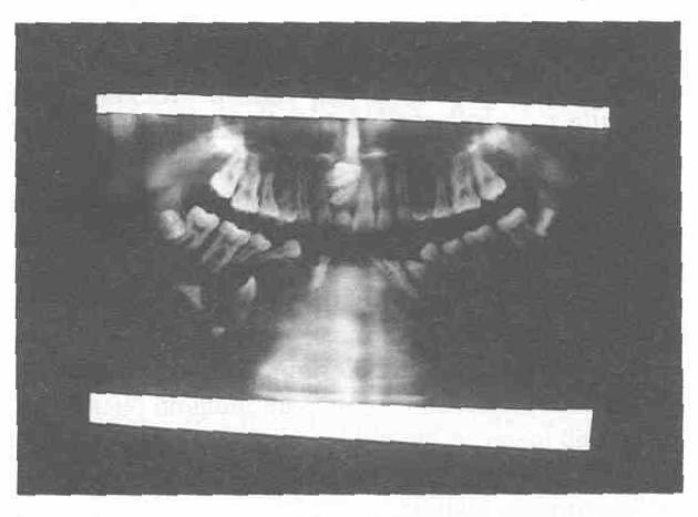 Bir olguda tüm anterior mandibulanın lezyon tarafından doldurulduğu izlendi (Resim 3a, 4a, 5).