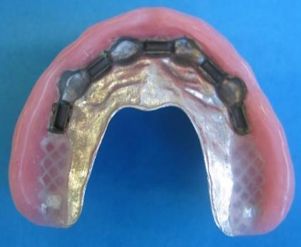Resim 10: Bar tutucunu ağızdaki görünümü Resim 8: Silikon rehber yardımıyla bar modelasyonun protez kaidesi içindeki konumunun