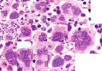 BCR-ABL negat f Kron k M yeloprol ferat fneoplaz lerde (KMPN) DSÖ 2008 sınıflandırması 143 ekil 1 KNPN Megakaryosit değişiklikleri.