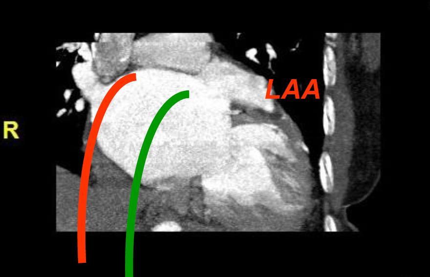 transeptal punture Aşağı