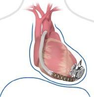LVAD (HM-III ve HVAD) 1.Giriş kanülü -Sol ventrikül apeks 2.Mekanik çark-aksamı (Sentrifugal sürekli akım, 3. jenerasyon) 3.Çıkış greft -Asendan aorta 4.