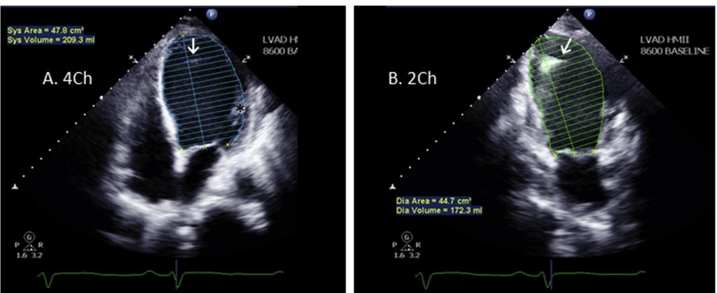 Recommendations for chamber quantification Figure 10 Methods of measuring right ventricular wall thickness (arrows) from an M-mode echo (left) and a subcostal transthoracic echo (right). Sol vent.