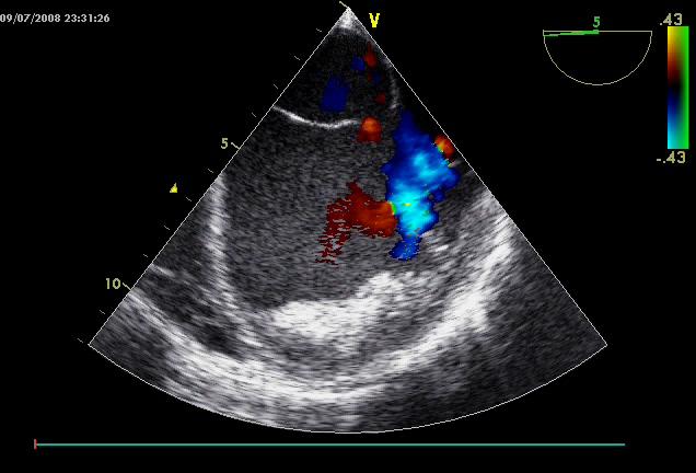 Downloaded from by guest on November 16, 2014 measurement due to the presence of epicardial fat deposition as well as coarse trabeculations within the right ventricle.