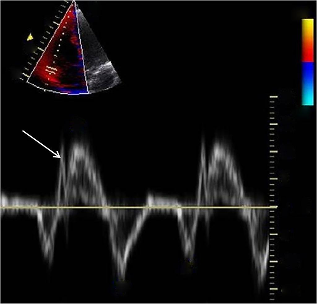 4 Cardiology Research and Practice (a) Echocardiographic assessment of the right ventricle the upper normal limits of indexed RV volumes as follows: RV Myocardial systolic excursion velocity (S ).