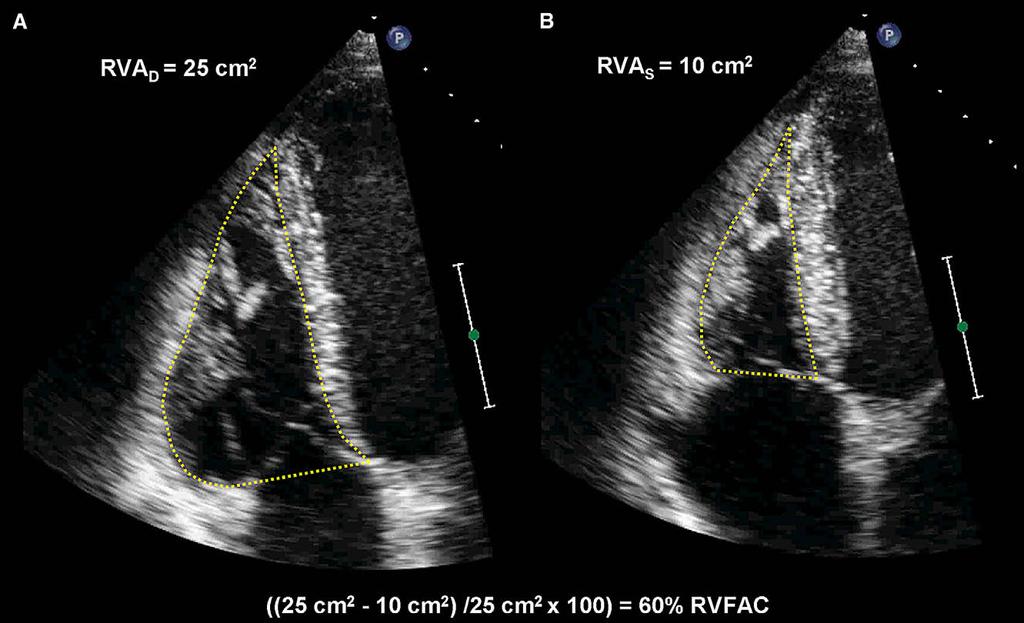 S is women, and RV end-systolic volume of 44 ml/m 2 in men and obtained using the A4C view, and measurement is typically 36 ml/m 2 in women.