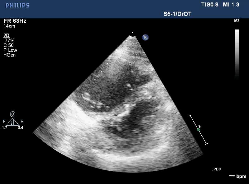 In cases of moderate enlargement, the RV cavity area is similar to that of the LV and it may share the apex of the heart.