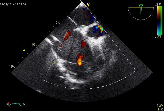 10 the tricuspid annular plane systolic excursion (TAPSE), DTIFractional linear shortening and area change. Fractional Figure 1: Methods for measuring LV function.