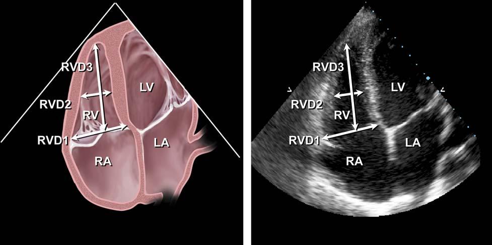 The mid-esophageal four- chamber view, which generally parallels what is obtainable from the apical four-chamber view, should originate at the mid-left atrial level and pass through the LV apex with