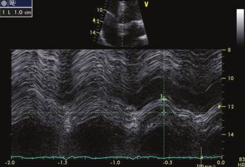 Right ventricular systolic function is generally estimated qualitatively in clinical practice.