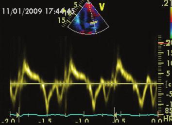 the lack of standard methods for assessing RV volumes. Nevertheless, a number of echocardiographic techniques may be used to assess RV function.
