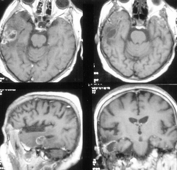 Şekil 4: Bazılarının nükleolleri belirgin, bazıları da binüklee ganglion hücrelerinin glial komponte göre daha baskın olduğu bir alan (HE X 200) Patoloji sonucu anaplastik