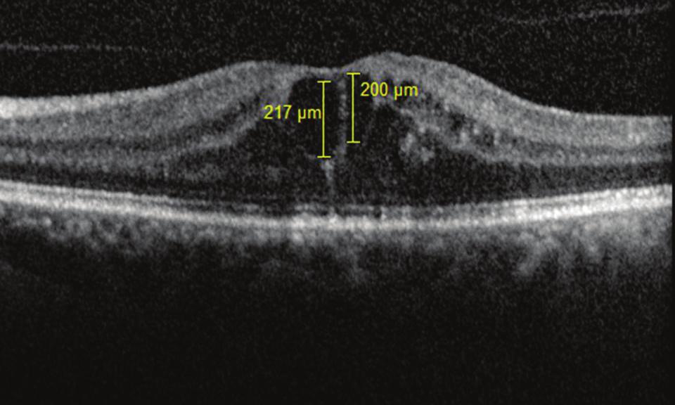 284 Retinal Ven Tıkanıklıklarında Optik Koherens Tomografi... GİRİŞ Retinal ven tıkanıklığı (RVO) retinanın vasküler hastalıkları arasında görme kaybına neden olan en sık ikinci hastalıktır.