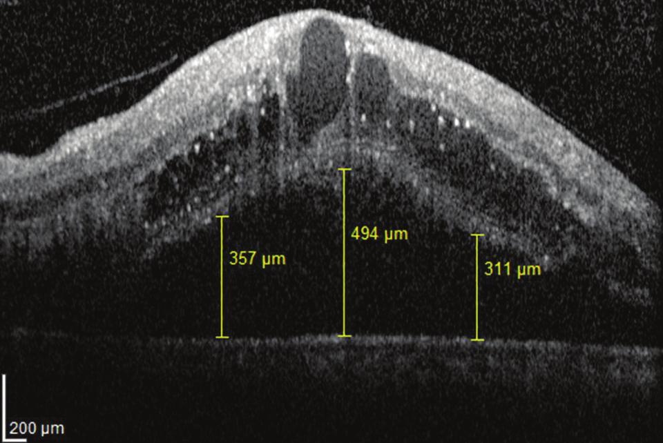 Ret-Vit 2014;22:283-288 Kaya ve ark. 285 Resim 3: OKT de santral retinal ven tıkanıklığına bağlı yoğun subretinal sıvının eşlik ettiği, <250 µm olan kistoid maküla ödemi ve retina kalınlığında artma.