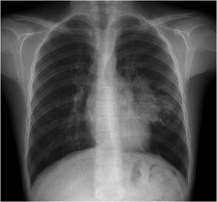Cilt 60 Sayı 1 Konjenital akciğer malformasyonu 5 Şekil 1. Konjenital pulmoner hava yolu malformasyonu olan bir olguda pnömonik konsolidasyon ve akciğerde kistik oluşum. Şekil 2.