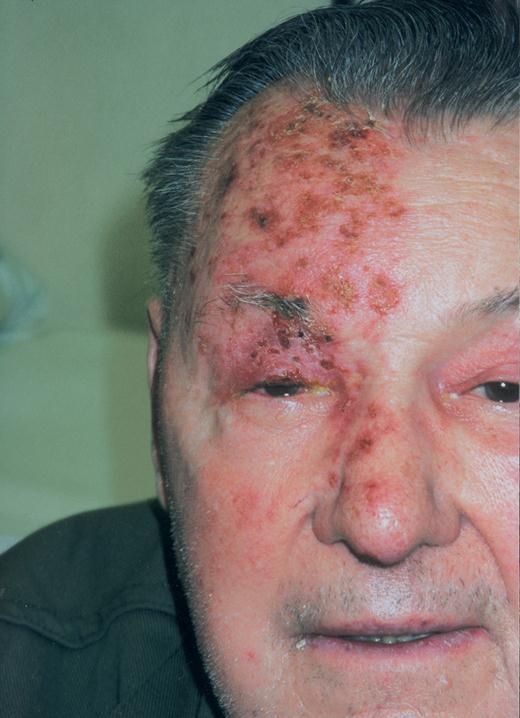 OKÜLER ENFEKSİYONLAR-KORNEA Herpes Zoster Oftalmikus: Trigeminal sinirin ilk dalı etkilenir. Döküntü genellikle orta çizgiyi geçmez ve sadece üst göz kapağını içerir.