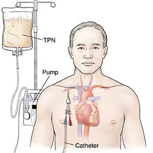 TPN Başlanması Oral ve Enteral beslenmesi kontrendike olan hastalarda TPN 3 ila 7 gün içerisinde başlanması önerilmektedir (B) Oral ve Enteral beslenmesi kontrendike olan hastalarda TPN 5 ila 7 gün