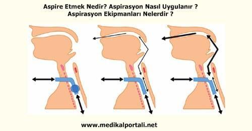 Gastrik Beslenme İntoleransı ve Aspirasyon Prokinetik ajanlarla çözülemeyen gastrik beslenme intoleranslarına karşın postpilorik beslenme önerilmektedir (B) Aspirasyon riskini azaltmak ve gastrik