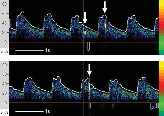 Ø SEREBRAL EMBOLİLERİN SAPTANMASI Embolik spikelar ile belirlenir Yüksek yoğunluklu geçici sinyaller (HITS) şeklinde toplam sayı hesaplanır Kaplan's Cardiac