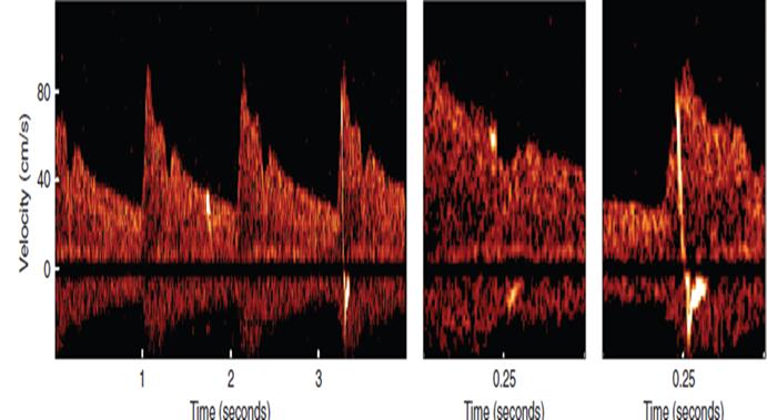 2011 25 makale, 4705 olgu TKD ile, MCA akım hızı ve MES (Mikroembolik sinyaller) değerlendirilmiş İnme ilişkisi incelenmiş TKD ile operatif emboli yükünün tespit