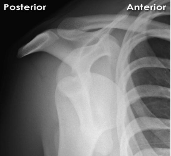 Normal glenohumeral eklem skapular Y