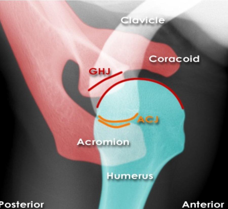 anterior glenohumeral çıkık  grafi