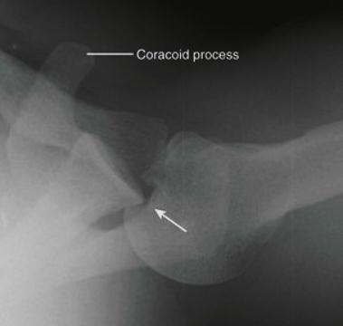 Aksiyel grafide posterior glenohumeral çıkık