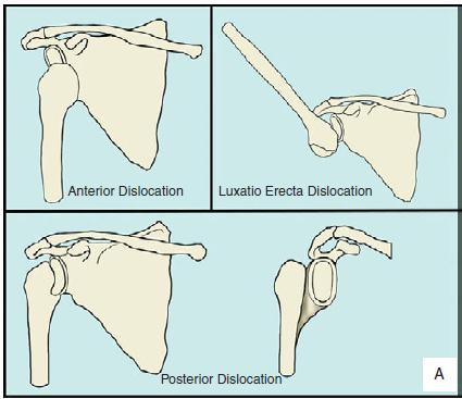 Omuz Çıkığı Tipleri Anterior >%95