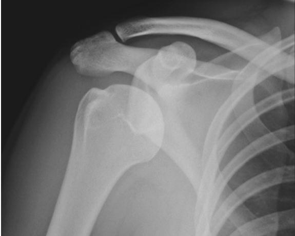 AP grafide anterior glenohumeral çıkık