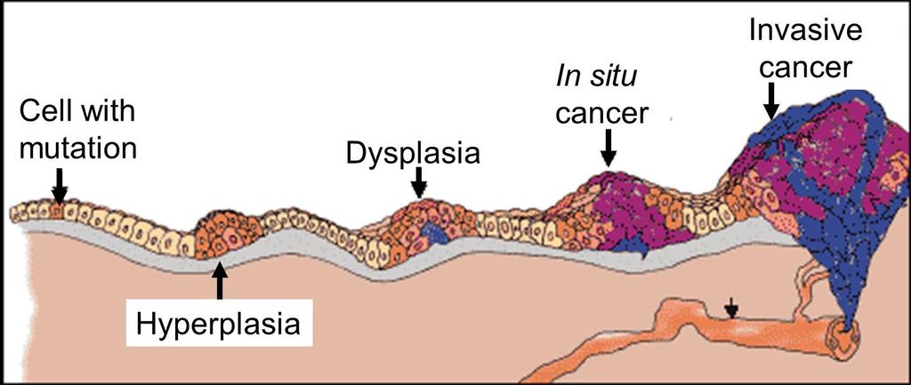 Mutasyonlu hücre Displazi Anormal büyüme, hücreler anormal İyi huylu Kanser Aynı doku içinde Kötü huylu kanser Başka organlara yayılma Hiperplazi Anormal büyüme, hücreler normal Tümörigenez