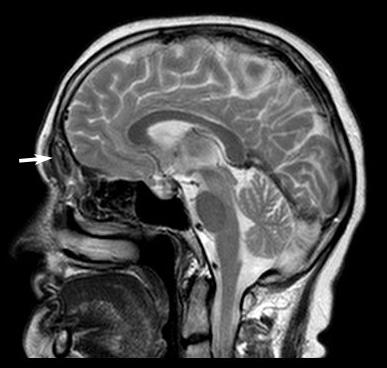 Şekil 3 : Preoperatif Manyetik rezonans görüntüleme (Ok işareti: frontal mukosel) Hastaya osteoplastik flep yaklaşımı ile frontal mukosel eksizyonu