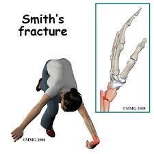 18 Şiddetli Travma (Acute Trauma) Kırıklar (Fractures): Kırıkların başlıca sebepleri düşme ve darbelerdir. Döşeme, zemin ve metal parçaları da bu yaralanmalara neden olan faktörlerdir.