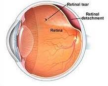 Retinal detachment is a disrder f the eye in which the retina peels away frm its underlying layer f supprt tissue.