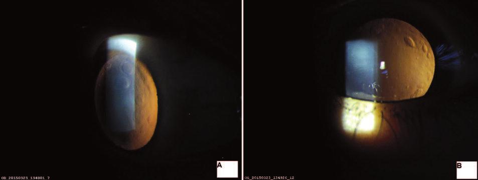 A B RESİM 1: Olgunun sağ (A) ve sol (B) gözünün biyomikroskobik görüntüleri. (Renkli hâli için Bkz. http://www.turkiyeklinikleri.