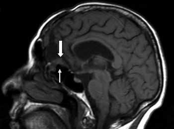 daha iyi ve ayrıntılı gösterir. T1-ağırlıklı (T1A) görüntülerde meningiom serebral kortekse benzer ya da hafif hipointens, T2-ağırlıklı (T2A) görüntülerdeyse gri cevhere göre hafif hiperintenstir.