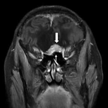 Meningiom gibi ekstra-aksiyel intradural lezyonların ayırımı için tanımlanan yarık işareti, lezyon ile beyin dokusu arasında BOS, damar ya da hipointens dura varlığında söylenebilir (Şekil 4A,B) (10).