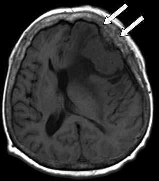 MRG ile meningiomların dural sinus invazyonu ve özellikle parasellar arteriyel sıkıştırma belirtileri hızlı T2A incelemelerle bile söylenebilir (Şekil 8).