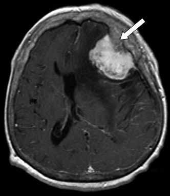Meningiomlarda Diffüzyon ağırlıklı görüntüleme bulguları Diffüzyon ağırlıklı görüntüleme (DAG) primer beyin tümörlerinin değerlendirilmesinde tanısal bir yöntem olarak yaygın şekilde kullanılmaktadır.