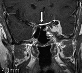 A) Falks meningiomlu hastanın koronal T2A görüntüsünde kitle ile beyin dokusu arasında hiperintens BOS (beyaz ok) ve damarlar (siyah ok) kitlenin ekstraaksiyel olduğunu