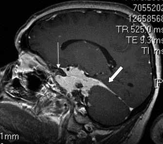 B) Sol kavernöz sinüs meningiomlu hastanın koronal T2A görüntüsünde, meningiom ile beyin dokusu arasındaki ince hiperintens BOS varlığı (küçük beyaz ok) ve kitle