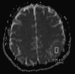 bildirilmiştir (13). A b c Şekil 8: Anterior falks meningiomu. A) Koronal T2A, B) Sagital kontrastlı MR Venografi, C) aksiyel kontrastlı MR Venografi.
