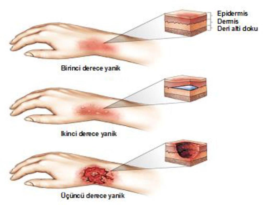 Yanığın genişliği Yanığın yeri Yanan kişiye ait risk faktörleri Yanığın Derinliği Yanığın derinliği, dört düzeyde derecelendirilerek belirlenir.