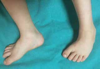 Çocuklarda ayak muayenesi 385 Şekil 1. Metatarsus adduktus. Ön ayak adduksiyondadır, ayak lateral kenarı eğimlidir ve topuk nötralde durur (fasulye şekli). Şekil 3.