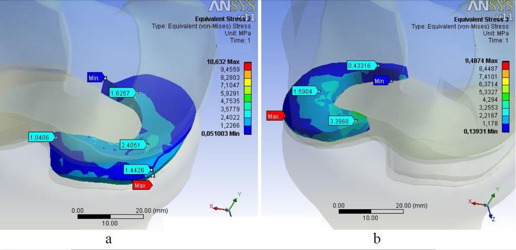 Atmaca ve Ark. Sakaryamj 2013;3(1):14-18 Femur Yapısal Hasarları ve Menisküslerde 17 En fazla eşdeğer gerilme medialde 10.632 MPa, lateralde ise 9.487 MPa olarak bulunmuştur.