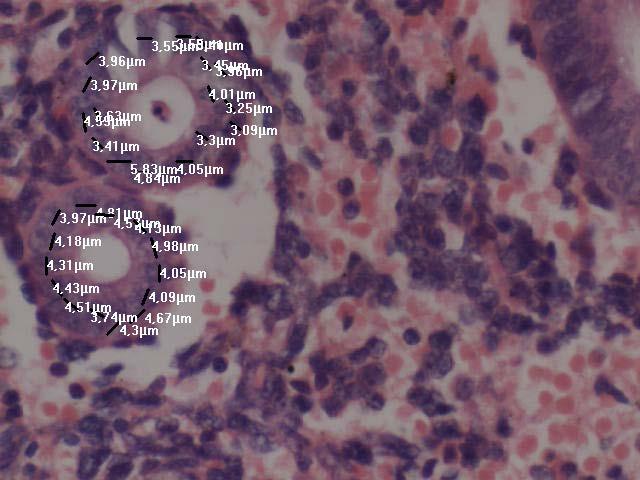 Proliferatif endometrium,atipisiz