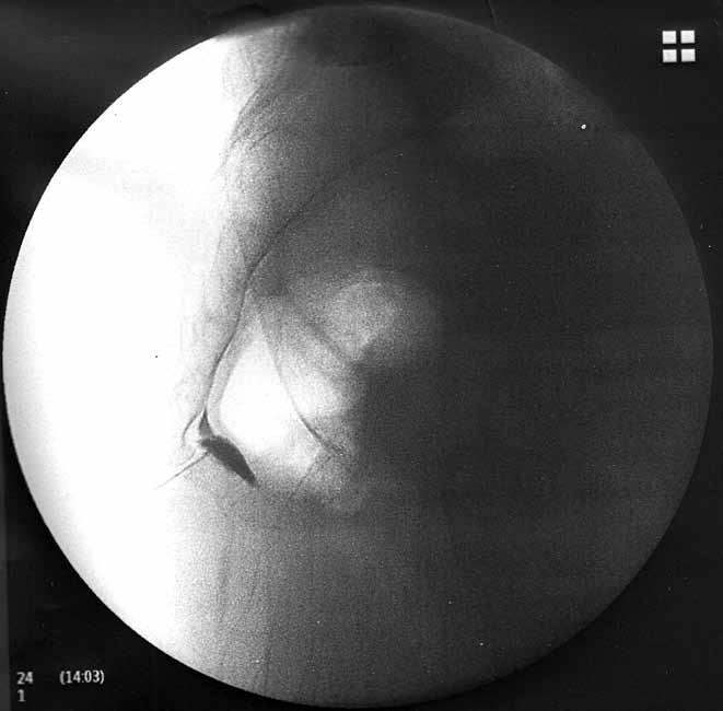 Koksiks dislokasyonlu hastada impar ganglion bloğu uygulaması Lateral fluoroskopik görüntüde iğnenin ucu koksiksin önüne geldiğinde 1 ml radyo opak verilerek virgül şeklinde yayılımı izlendi (Şekil