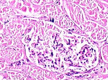 9 NaCl) solüsyonu çalışma grubuyla yapılan radyofrekans ablasyon uygulaması sonrasında böbrekte oluşan kuaglasyon nekrozu ve parankim değişikliklerin histo-patolojik görünümü GRUP 2 Yüzde 3,6 NaCl