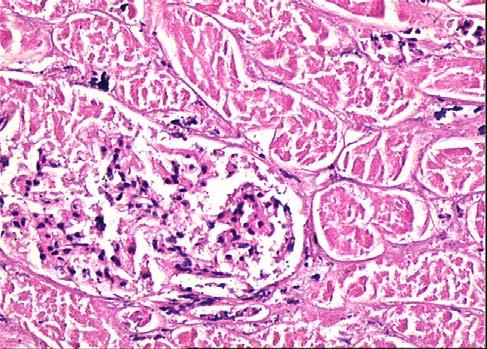 9 Potasyum klorür solüsyonu çalışma grubuyla yapılan radyofrekans ablasyon uygulaması sonrasında böbrekte oluşan kuaglasyon nekrozu ve parankim değişikliklerin histo-patolojik görünümü GRUP 4 Yüzde 3.