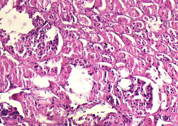 6 Potasyum klorür solüsyonu çalışma grubuyla yapılan radyofrekans ablasyon uygulaması sonrasında böbrekte oluşan kuaglasyon nekrozu ve parankim değişikliklerin histo-patolojik görünümü GRUP 5 Yüzde 5
