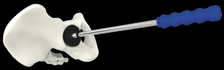 Kesilen femur başı, Femur Başı Çıkarıcısıyla (Femoral Head